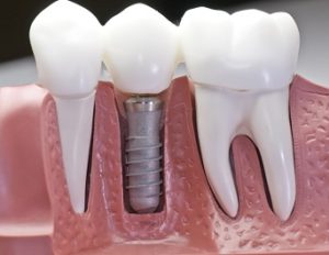 Clinica New Dental Toledo Implantología