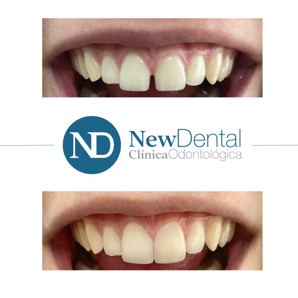 Clínica New Dental. Especialistas en Carillas de composite en Toledo