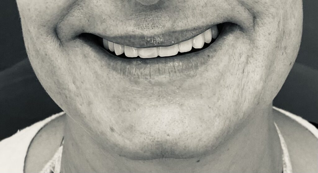 Diseño de sonrisas. Clínica New Dental Toledo
