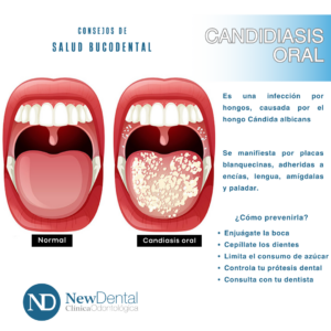 Candidiasis Oral Clínica New Dental Toledo
