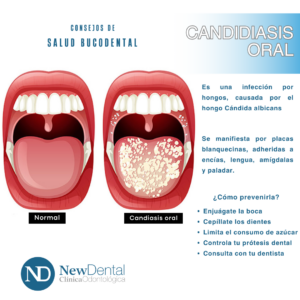 Lee más sobre el artículo Candidiasis oral