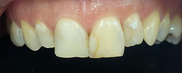 Carillas dentales Clinica New Dental Toledo