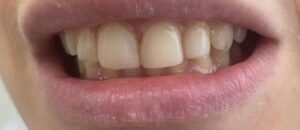 Lee más sobre el artículo ¿Aprietas o rechinas los dientes? 😬 ¡Podrías estar sufriendo de bruxismo!