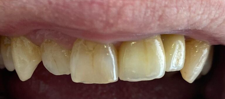 CORONA SOBRE IMPLANTES poligono Toledo Madrid