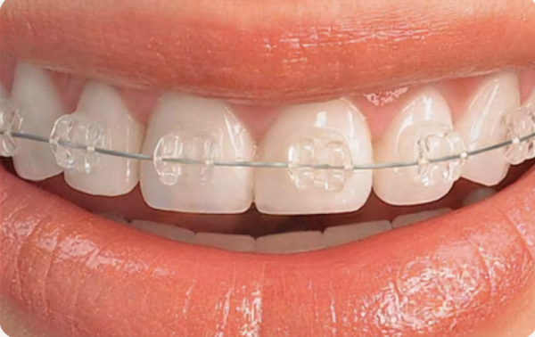 brackets-esteticos-ortodoncia-clinica-new-dental-toledo