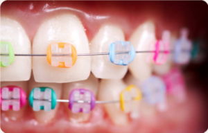 brackets-metalicos-ortodoncia-clinica-new-dental-toledo