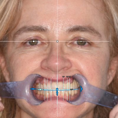 DSD Susana Clínica New Dental Toledo - material 02